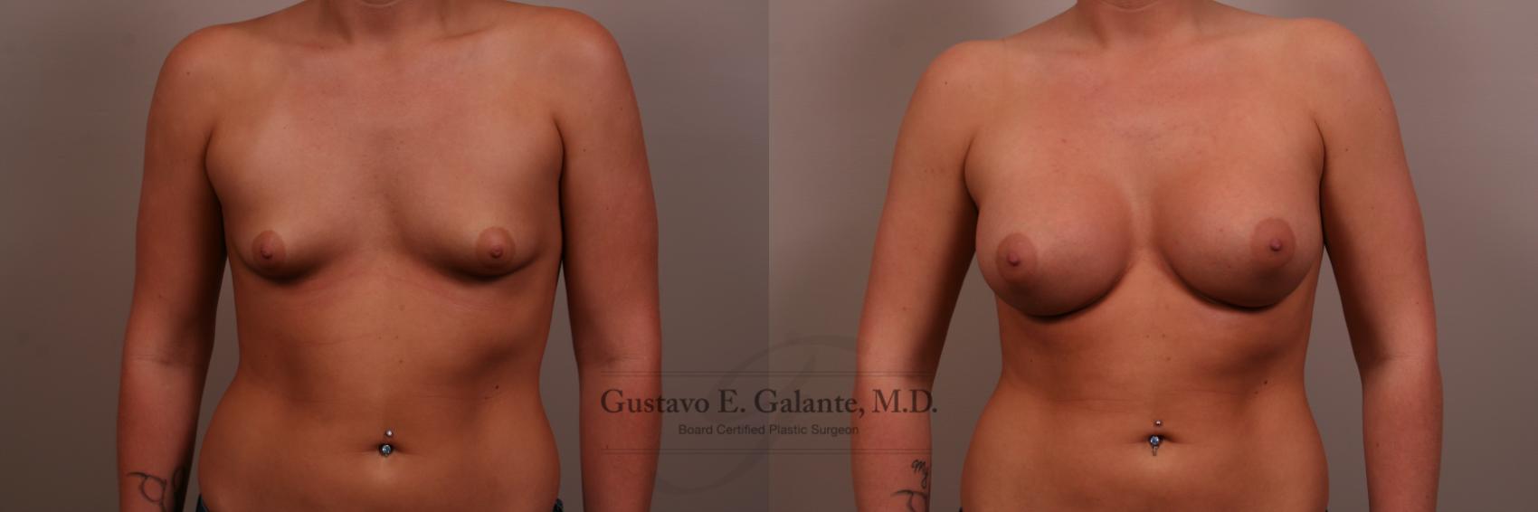 Breast Augmentation Case 102 Before & After View #1 | Valparaiso & Schererville, IN | Gustavo E. Galante, MD