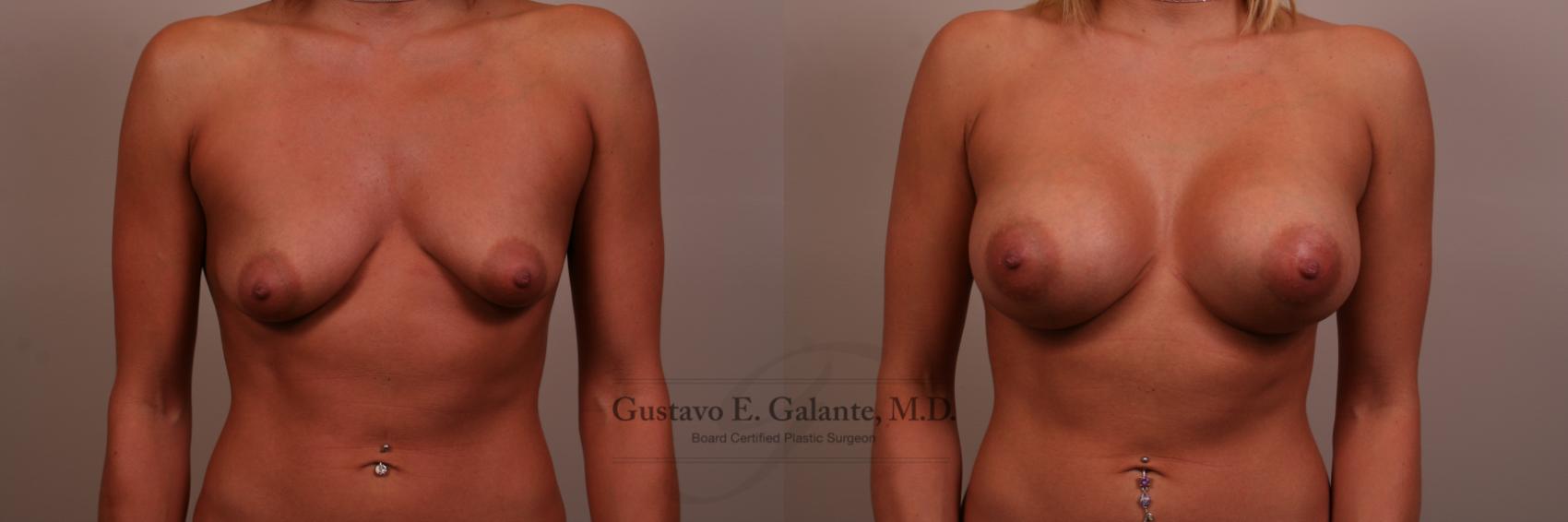 Breast Augmentation Case 104 Before & After View #1 | Valparaiso & Schererville, IN | Gustavo E. Galante, MD