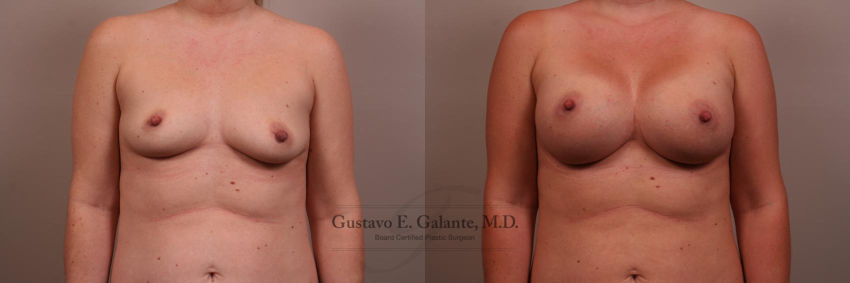Breast Augmentation Case 106 Before & After View #1 | Valparaiso & Schererville, IN | Gustavo E. Galante, MD