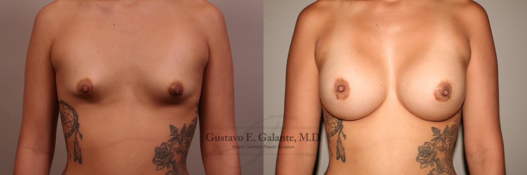 Breast Augmentation Case 109 Before & After View #1 | Valparaiso & Schererville, IN | Gustavo E. Galante, MD