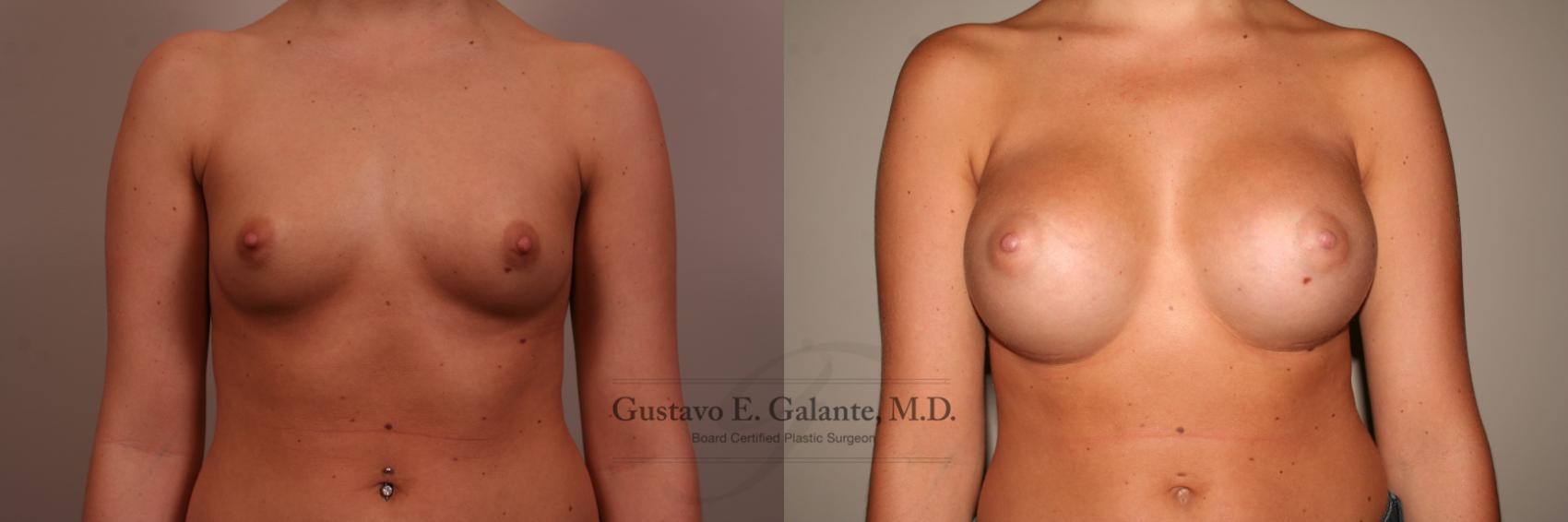 Breast Augmentation Case 113 Before & After View #1 | Valparaiso & Schererville, IN | Gustavo E. Galante, MD