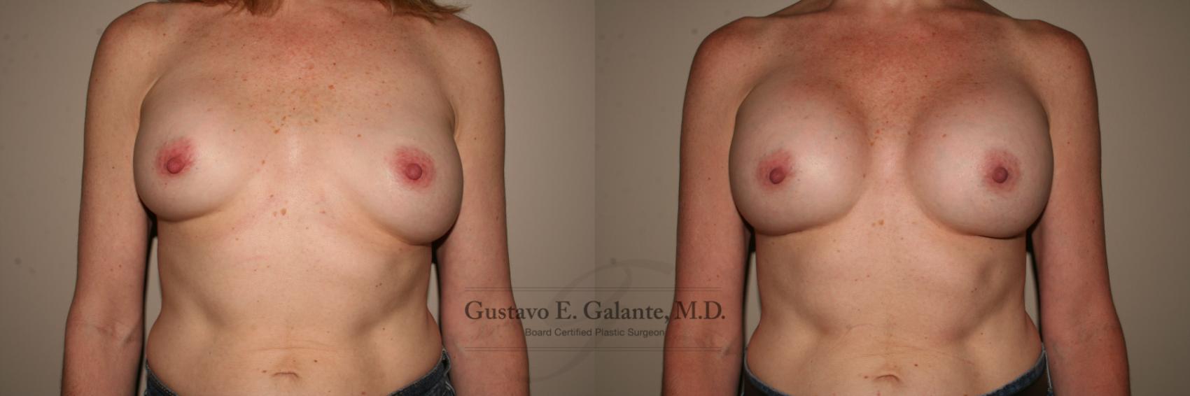 Breast Augmentation Case 115 Before & After View #1 | Valparaiso & Schererville, IN | Gustavo E. Galante, MD