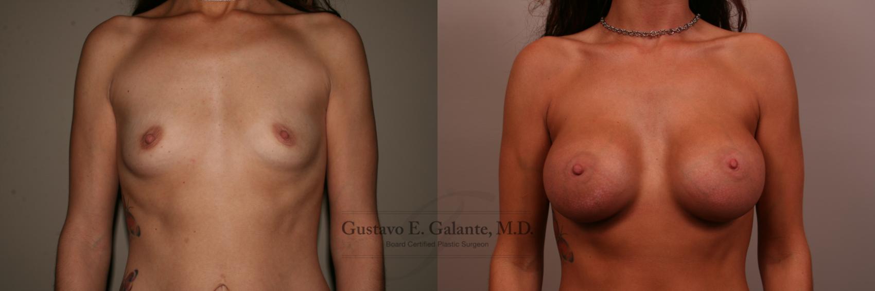 Breast Augmentation Case 119 Before & After View #1 | Valparaiso & Schererville, IN | Gustavo E. Galante, MD