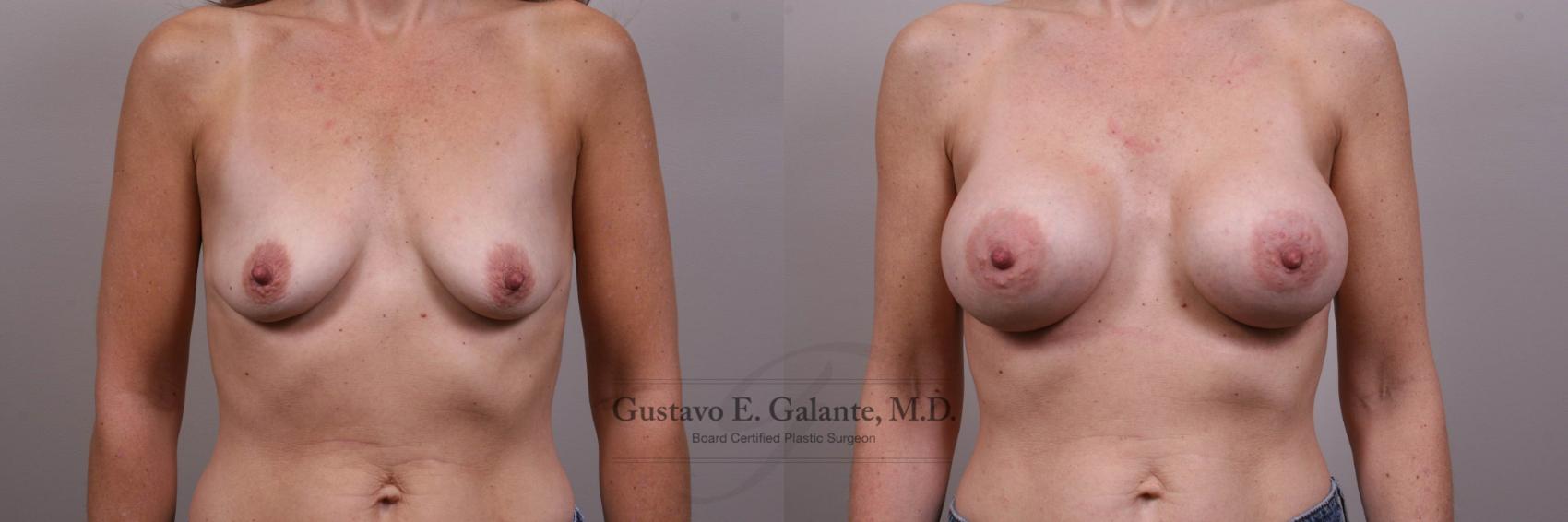 Breast Augmentation Case 127 Before & After View #1 | Valparaiso & Schererville, IN | Gustavo E. Galante, MD