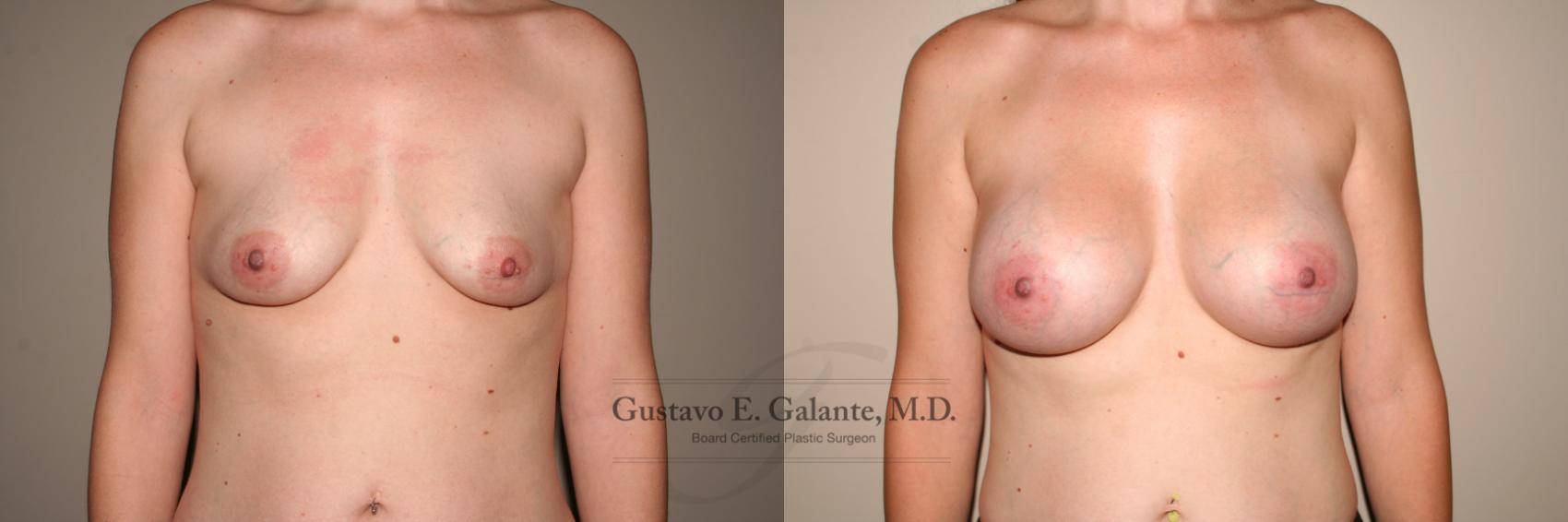 Breast Augmentation Case 133 Before & After View #1 | Valparaiso & Schererville, IN | Gustavo E. Galante, MD