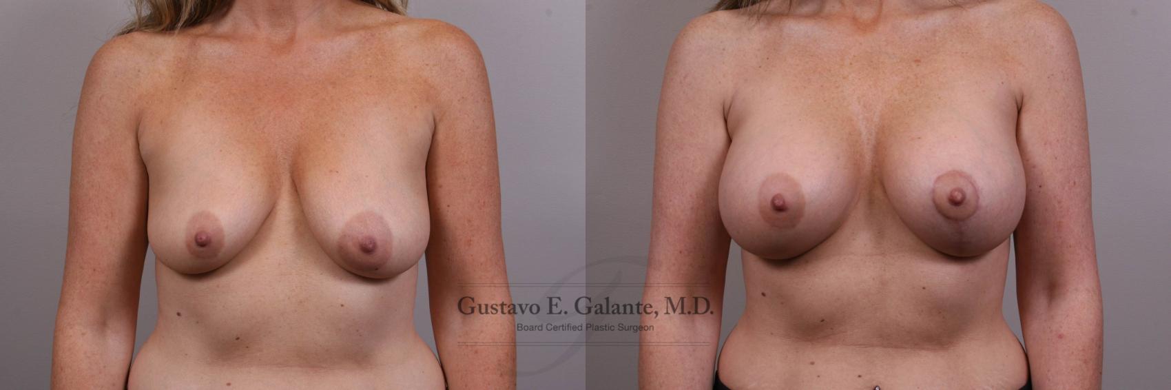 Breast Augmentation Case 134 Before & After View #1 | Valparaiso & Schererville, IN | Gustavo E. Galante, MD