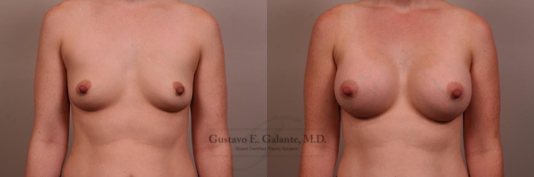 Breast Augmentation Case 137 Before & After View #1 | Valparaiso & Schererville, IN | Gustavo E. Galante, MD