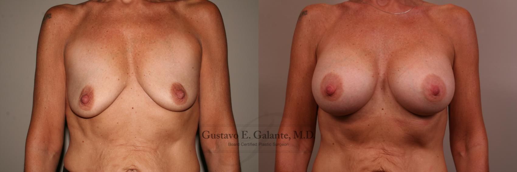 Breast Augmentation Case 139 Before & After View #1 | Valparaiso & Schererville, IN | Gustavo E. Galante, MD