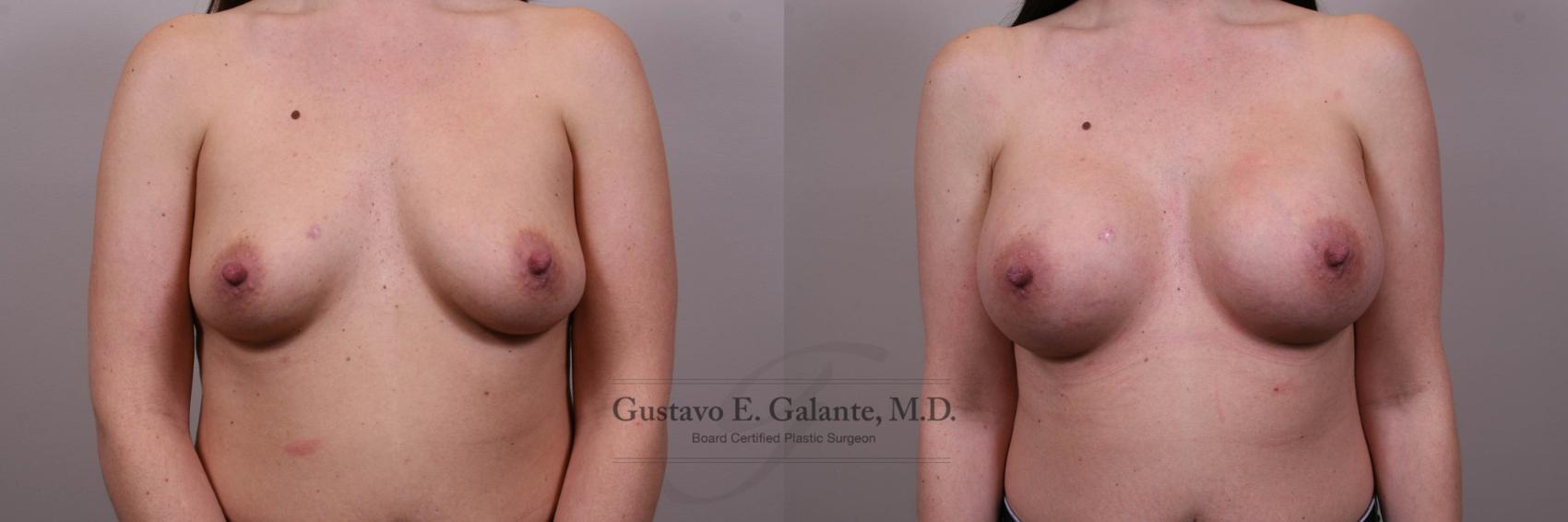 Breast Augmentation Case 148 Before & After View #1 | Valparaiso & Schererville, IN | Gustavo E. Galante, MD