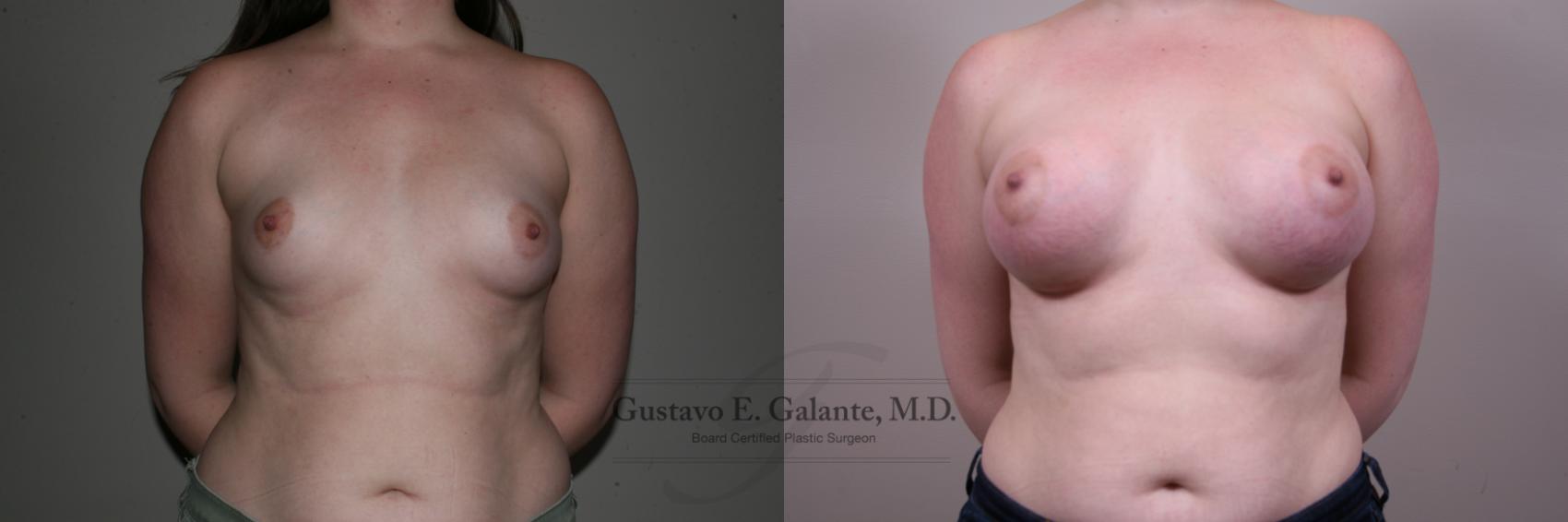 Breast Augmentation Case 169 Before & After View #1 | Valparaiso & Schererville, IN | Gustavo E. Galante, MD