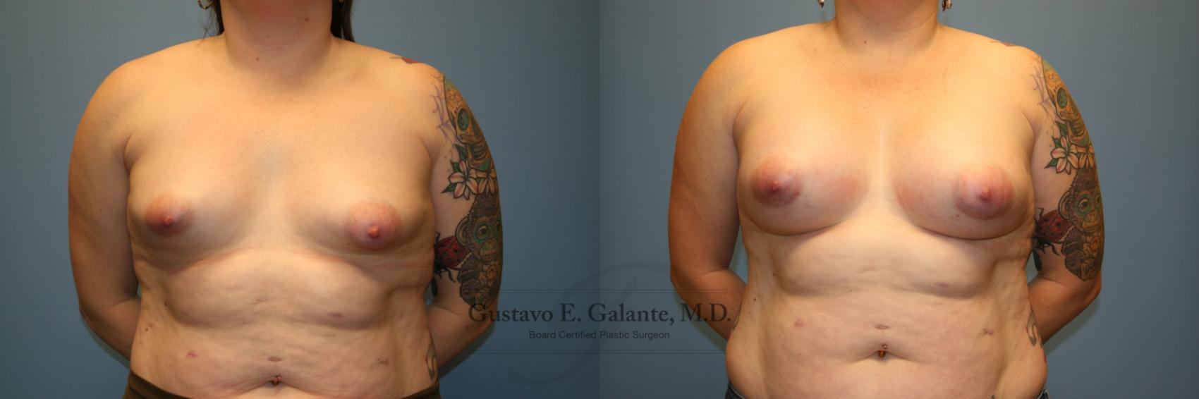 Breast Augmentation Case 207 Before & After Front | Valparaiso & Schererville, IN | Gustavo E. Galante, MD
