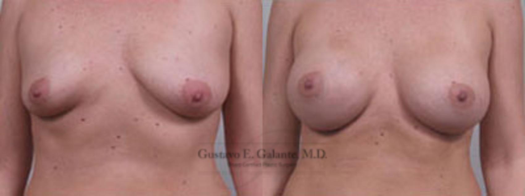 Breast Augmentation Case 44 Before & After View #1 | Valparaiso & Schererville, IN | Gustavo E. Galante, MD