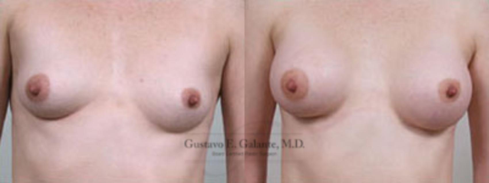 Breast Augmentation Case 6 Before & After View #1 | Valparaiso & Schererville, IN | Gustavo E. Galante, MD