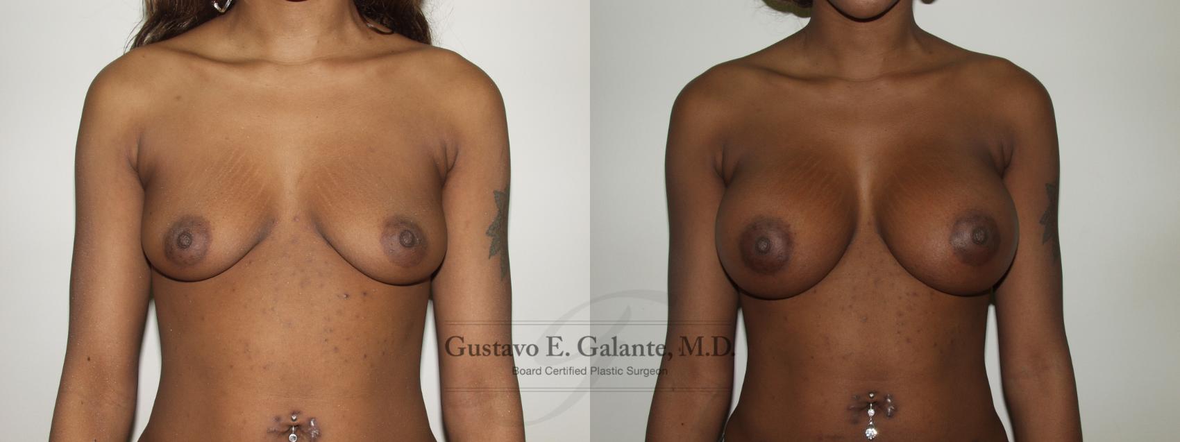 Breast Augmentation Case 72 Before & After View #1 | Valparaiso & Schererville, IN | Gustavo E. Galante, MD