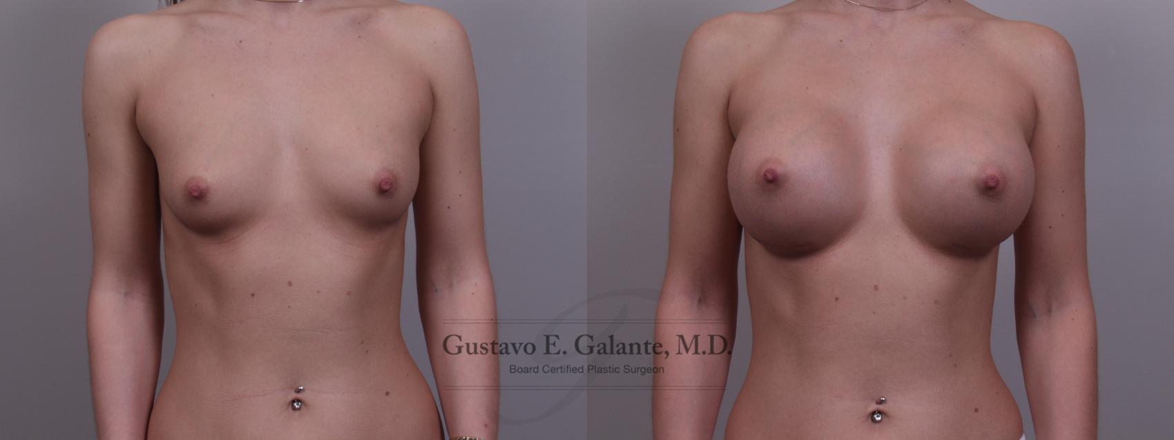 Breast Augmentation Case 85 Before & After View #1 | Valparaiso & Schererville, IN | Gustavo E. Galante, MD