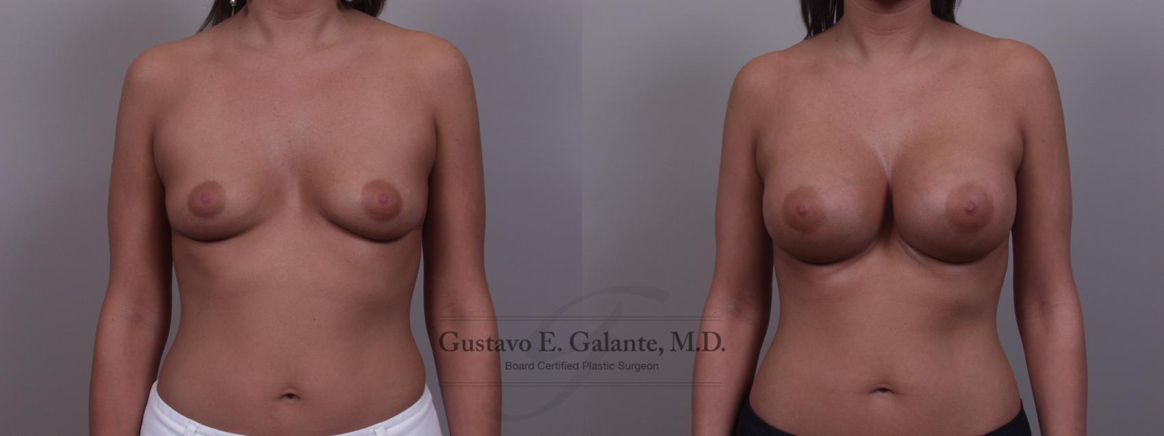 Breast Augmentation Case 89 Before & After View #1 | Valparaiso & Schererville, IN | Gustavo E. Galante, MD
