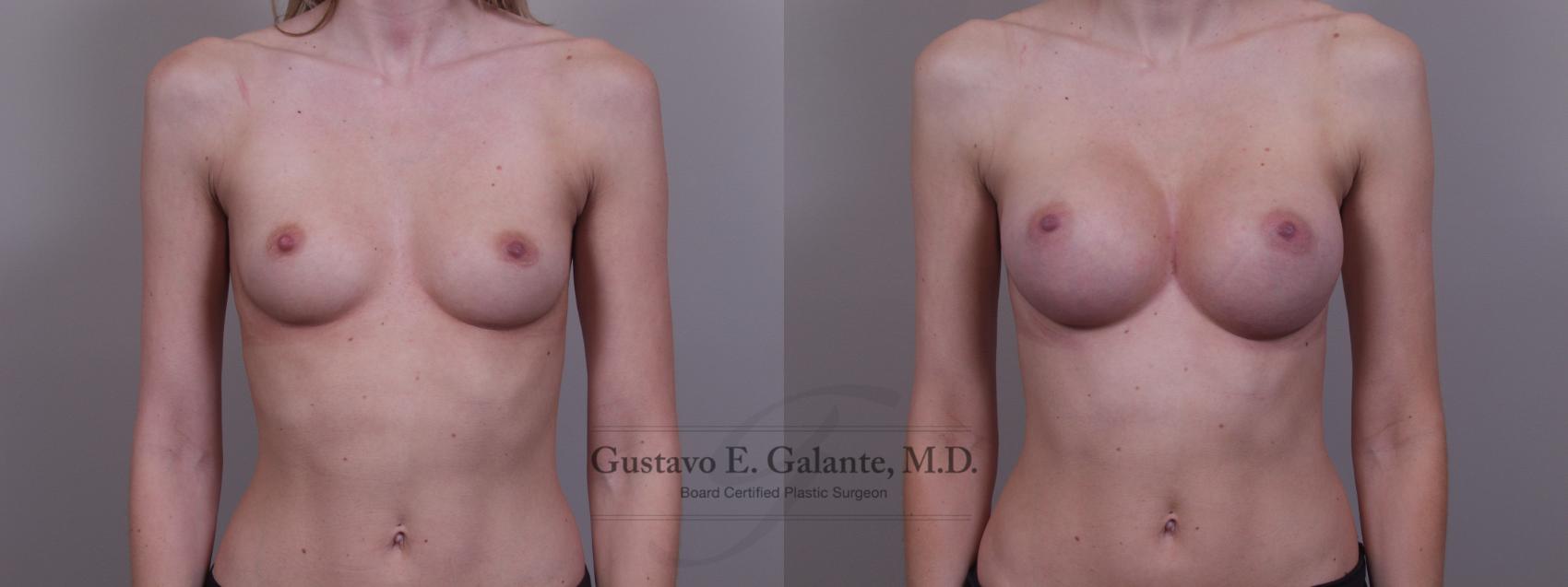 Breast Augmentation Case 90 Before & After View #1 | Valparaiso & Schererville, IN | Gustavo E. Galante, MD