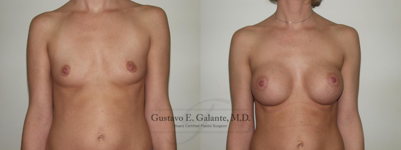 Breast Augmentation Case 92 Before & After View #1 | Valparaiso & Schererville, IN | Gustavo E. Galante, MD