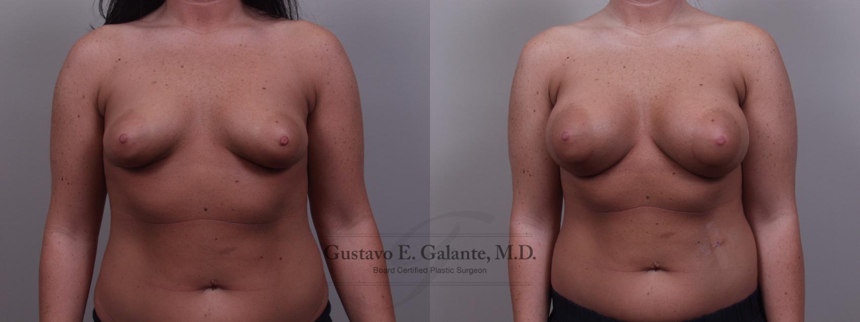 Breast Augmentation Case 99 Before & After View #1 | Valparaiso & Schererville, IN | Gustavo E. Galante, MD