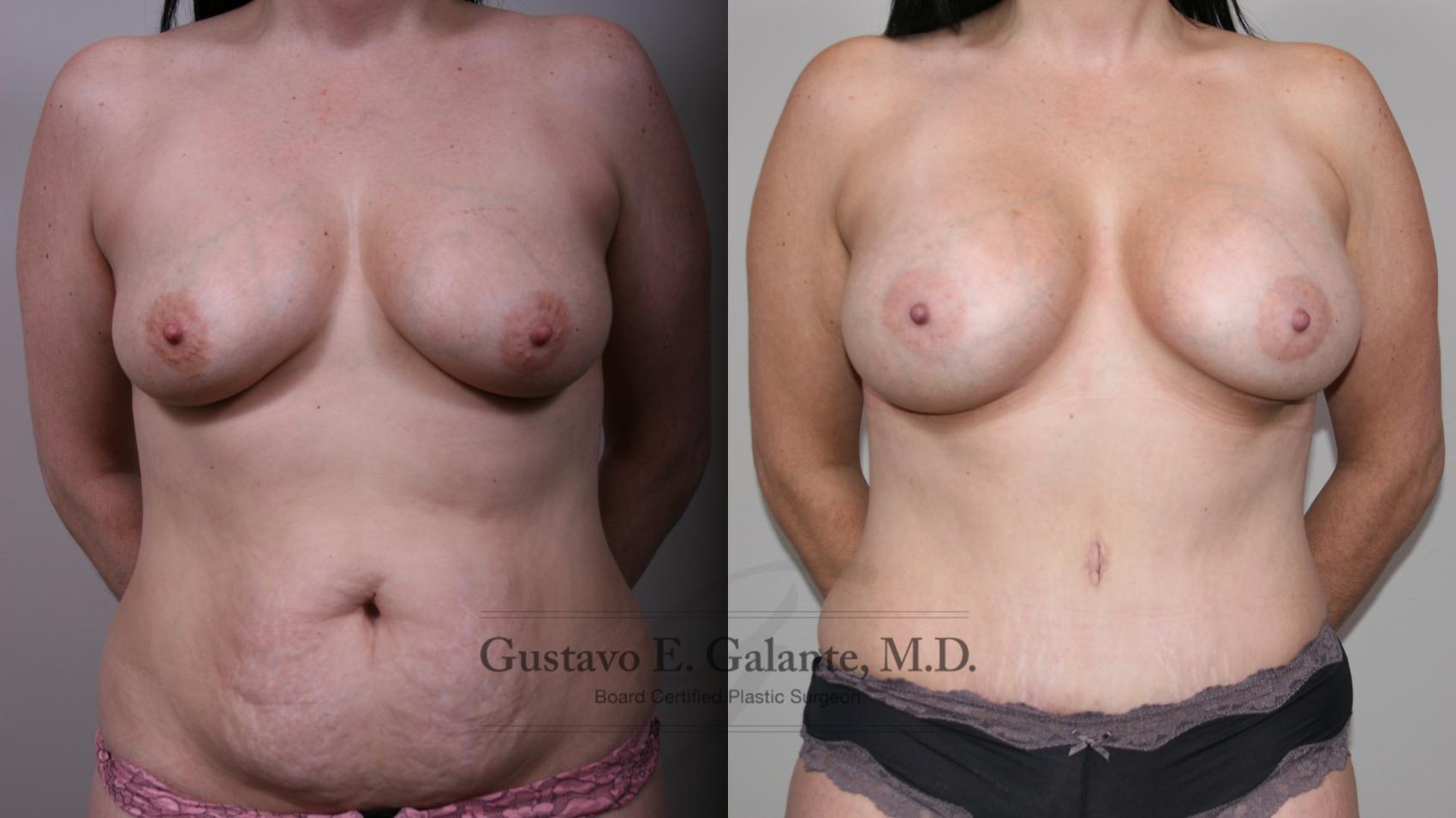 Mommy Makeover Case 195 Before & After Front | Valparaiso & Schererville, IN | Gustavo E. Galante, MD