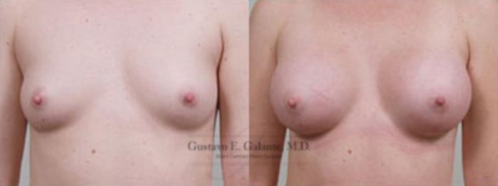 Before & After Breast Augmentation Case 1 View #1 View in Schererville, IN