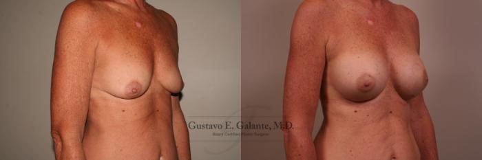 Before & After Breast Augmentation Case 121 View #1 View in Schererville, IN