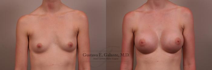 Before & After Breast Augmentation Case 123 View #1 View in Schererville, IN