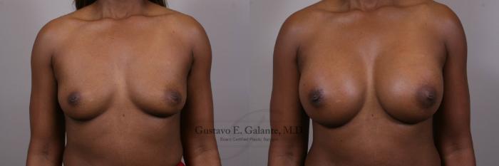 Before & After Breast Augmentation Case 152 View #1 View in Schererville, IN