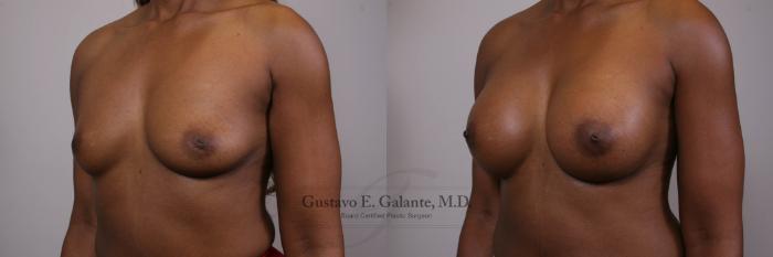 Before & After Breast Augmentation Case 152 View #2 View in Schererville, IN