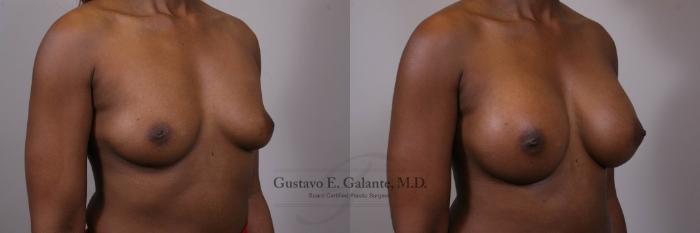 Before & After Breast Augmentation Case 152 View #3 View in Schererville, IN
