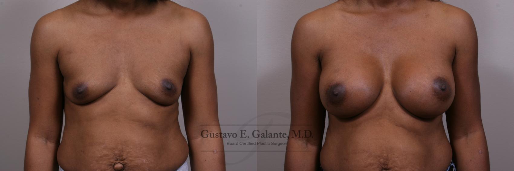 Before & After Breast Augmentation Case 153 View #1 View in Schererville, IN
