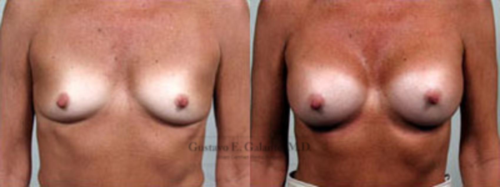 Before & After Breast Augmentation Case 3 View #1 View in Valparaiso & Schererville, IN