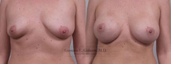 Before & After Breast Augmentation Case 44 View #1 View in Schererville, IN