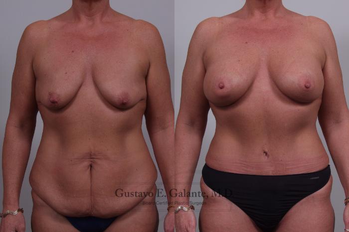Before & After Breast Augmentation Case 47 View #1 View in Schererville, IN
