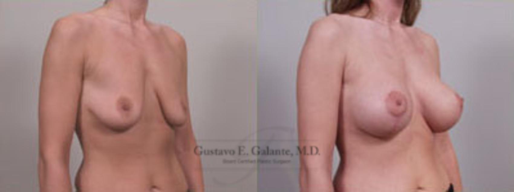 Before & After Breast Lift (Mastopexy) Case 10 View #1 View in Schererville, IN