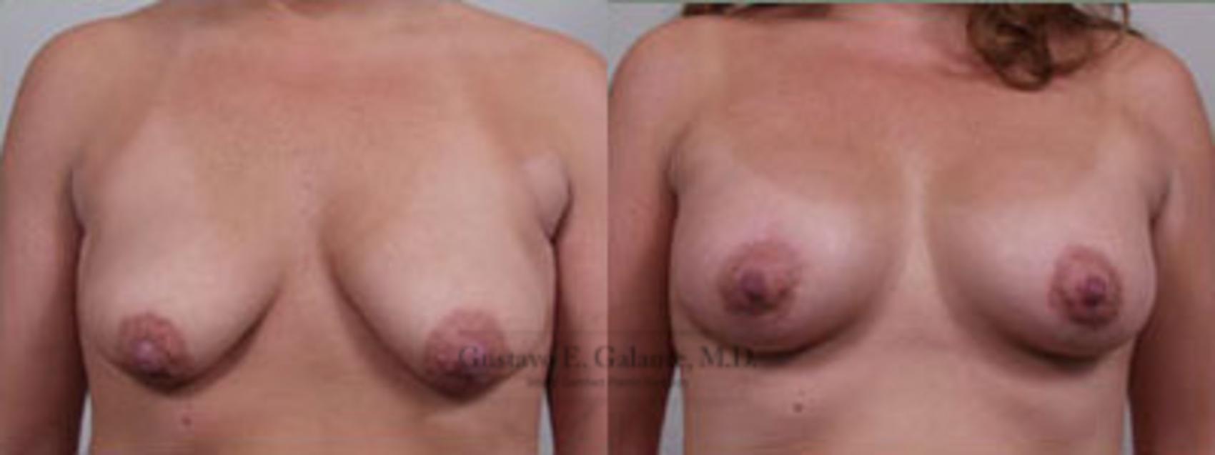 Before & After Breast Lift (Mastopexy) Case 9 View #1 View in Valparaiso & Schererville, IN