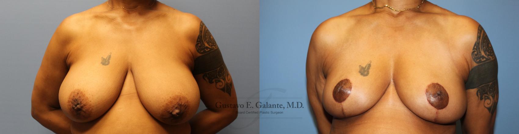 Before & After Breast Reduction Case 204 Front View in Schererville, IN