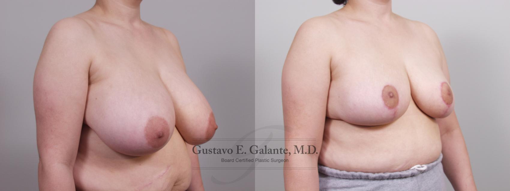 Before & After Breast Reduction Case 68 View #2 View in Schererville, IN