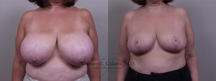Before & After Breast Reduction Case 69 View #1 View in Schererville, IN