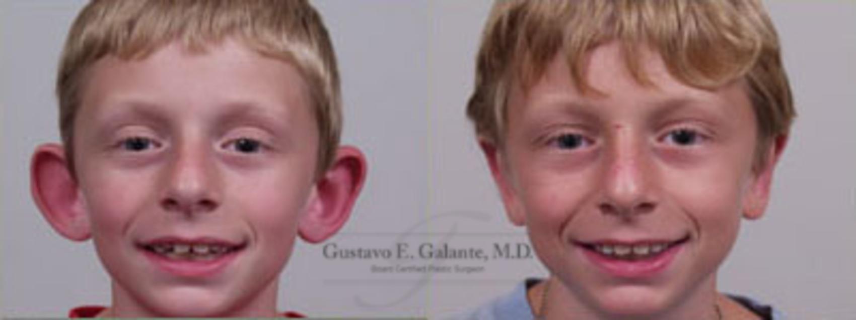 Before & After Ear Surgery (Otoplasty) Case 43 View #1 View in Schererville, IN