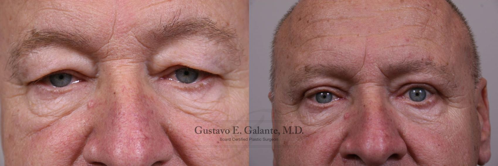 Eyelid Surgery In Indiana With Dr Gus Galante Dr Galante
