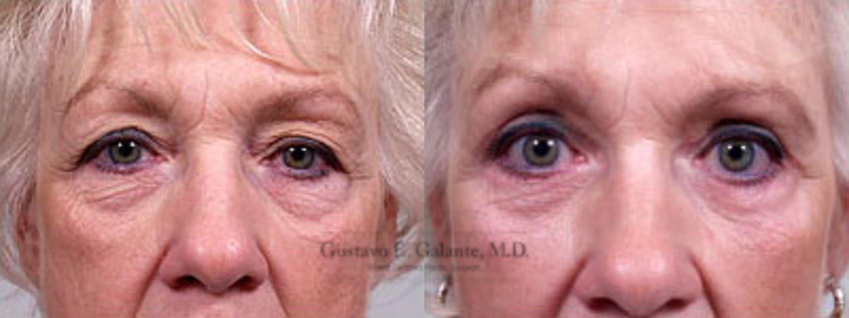 Before & After Eyelid Surgery (Blepharoplasty) Case 160 View #1 View in Schererville, IN
