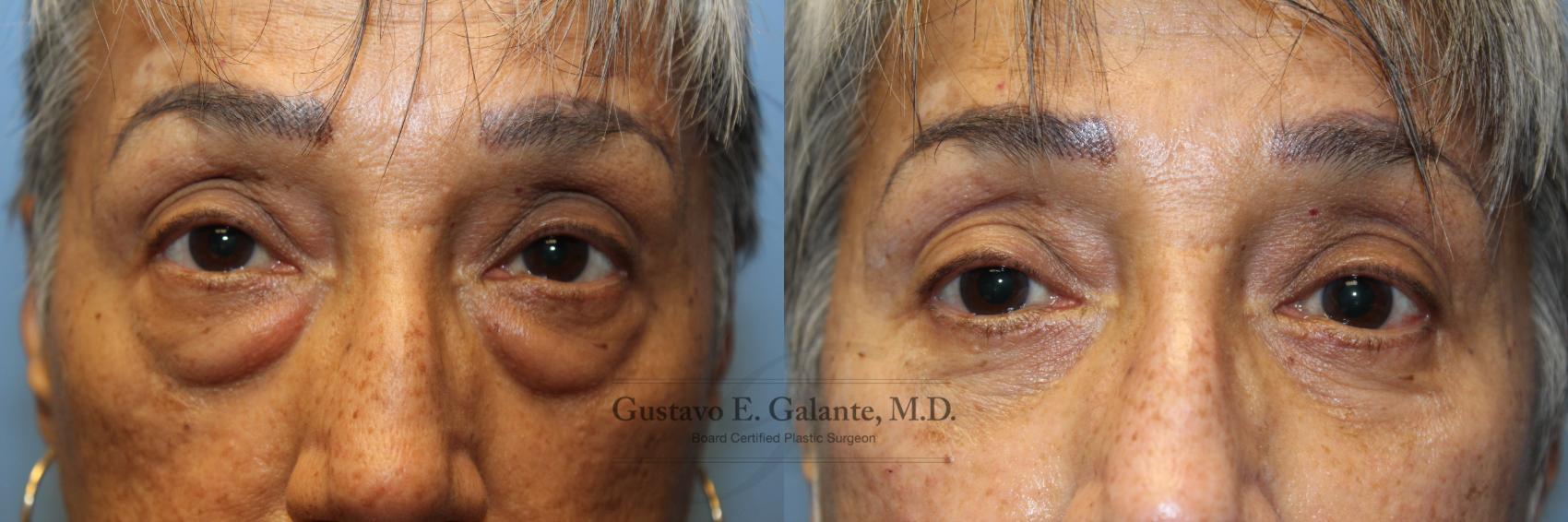 Puffy Eyes and Bags with Eyelid Surgery