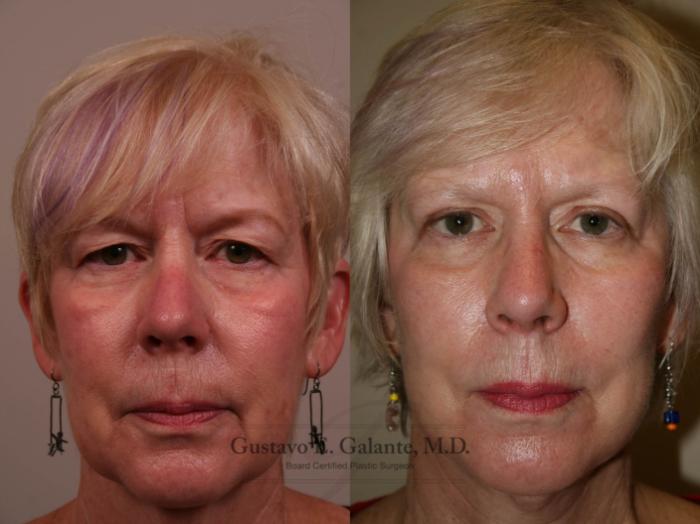 Before & After Facelift Case 130 View #1 View in Schererville, IN