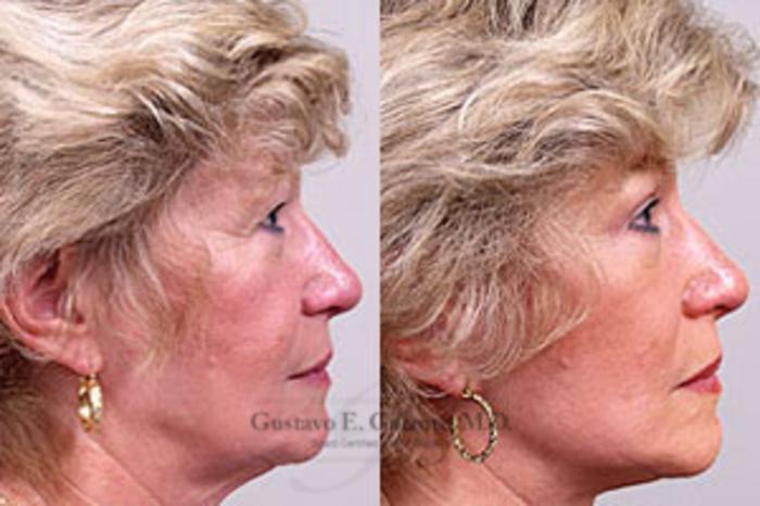 Before & After Facelift Case 20 View #1 View in Schererville, IN