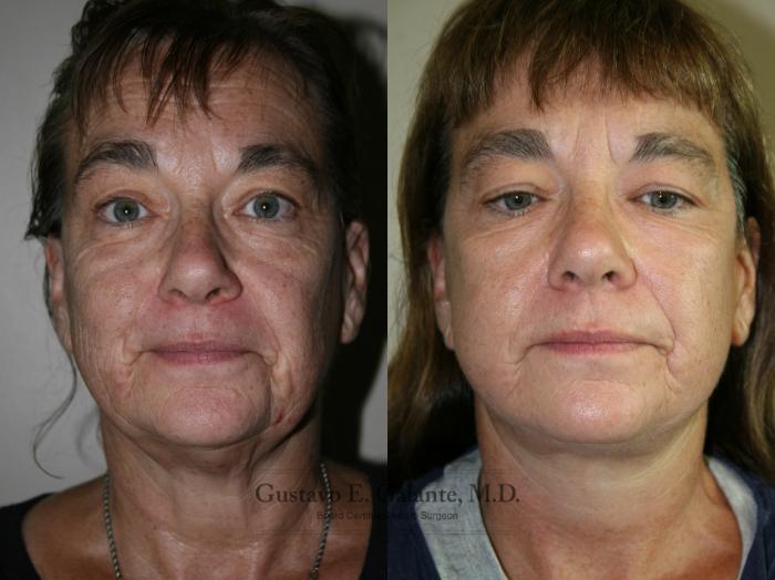 Before & After Facelift Case 209 Front View in Schererville, IN