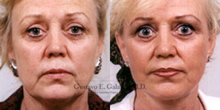 Before & After Facelift Case 21 View #1 View in Schererville, IN