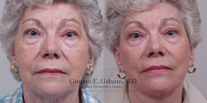 Before & After Facelift Case 22 View #1 View in Schererville, IN
