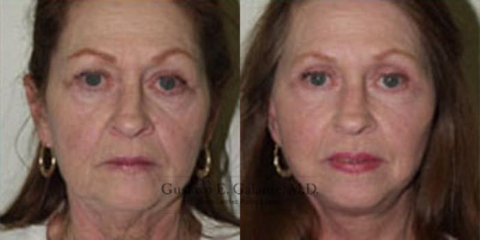 Before & After Facelift Case 23 View #1 View in Schererville, IN