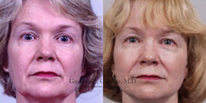 Before & After Facelift Case 24 View #1 View in Schererville, IN